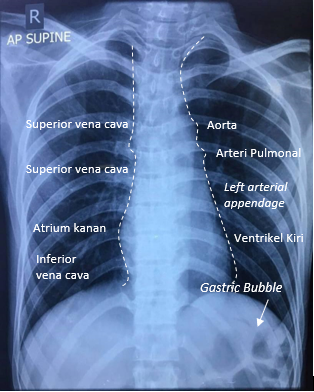 Detail Gambaran Radiologi Fibrosis Paru Nomer 2