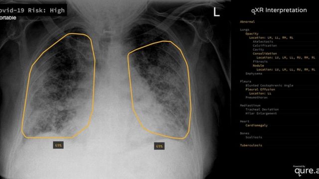 Detail Gambaran Radiologi Fibrosis Paru Nomer 16