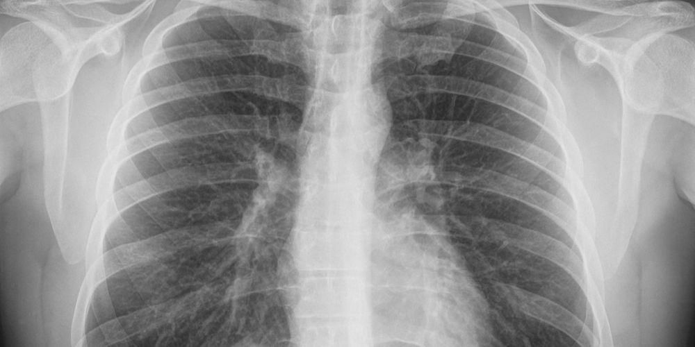 Detail Gambaran Radiologi Fibrosis Paru Nomer 29