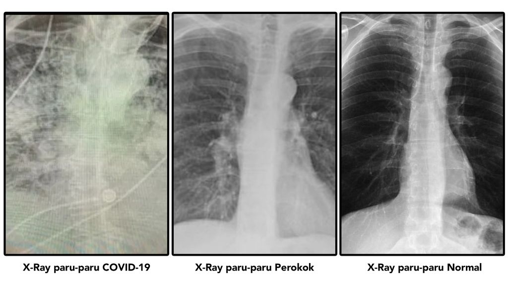 Detail Gambaran Radiologi Fibrosis Paru Nomer 6