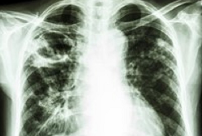 Detail Gambaran Radiologi Fibrosis Paru Nomer 40