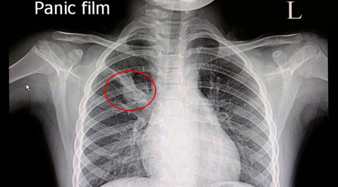 Detail Gambaran Radiologi Fibrosis Paru Nomer 8
