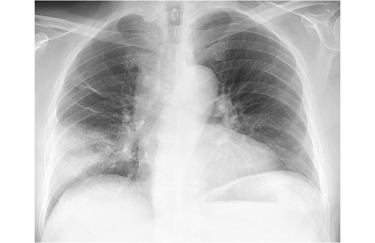 Detail Gambaran Radiologi Pneumonia Nomer 13