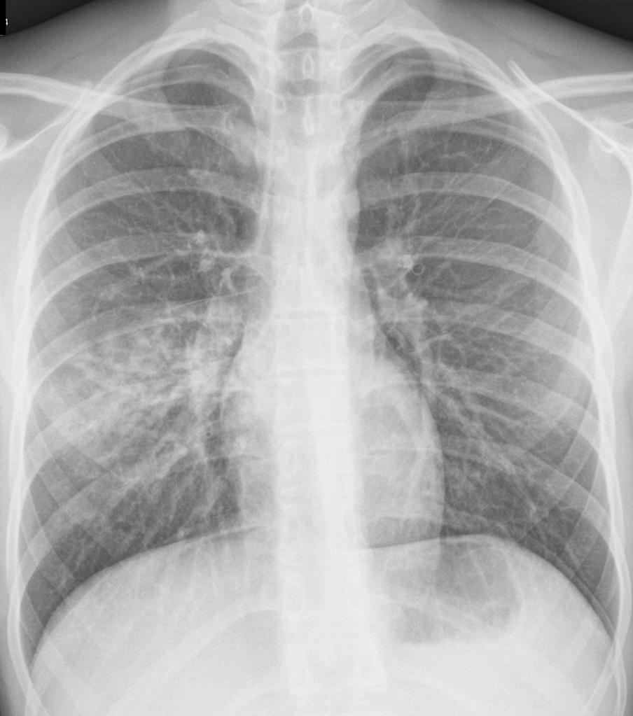 Detail Gambaran Radiologi Pneumonia Nomer 16