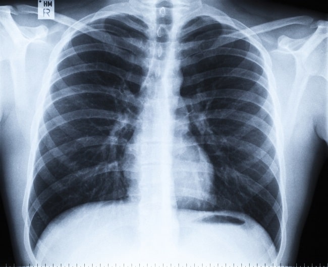 Detail Gambaran Radiologi Pneumonia Nomer 17