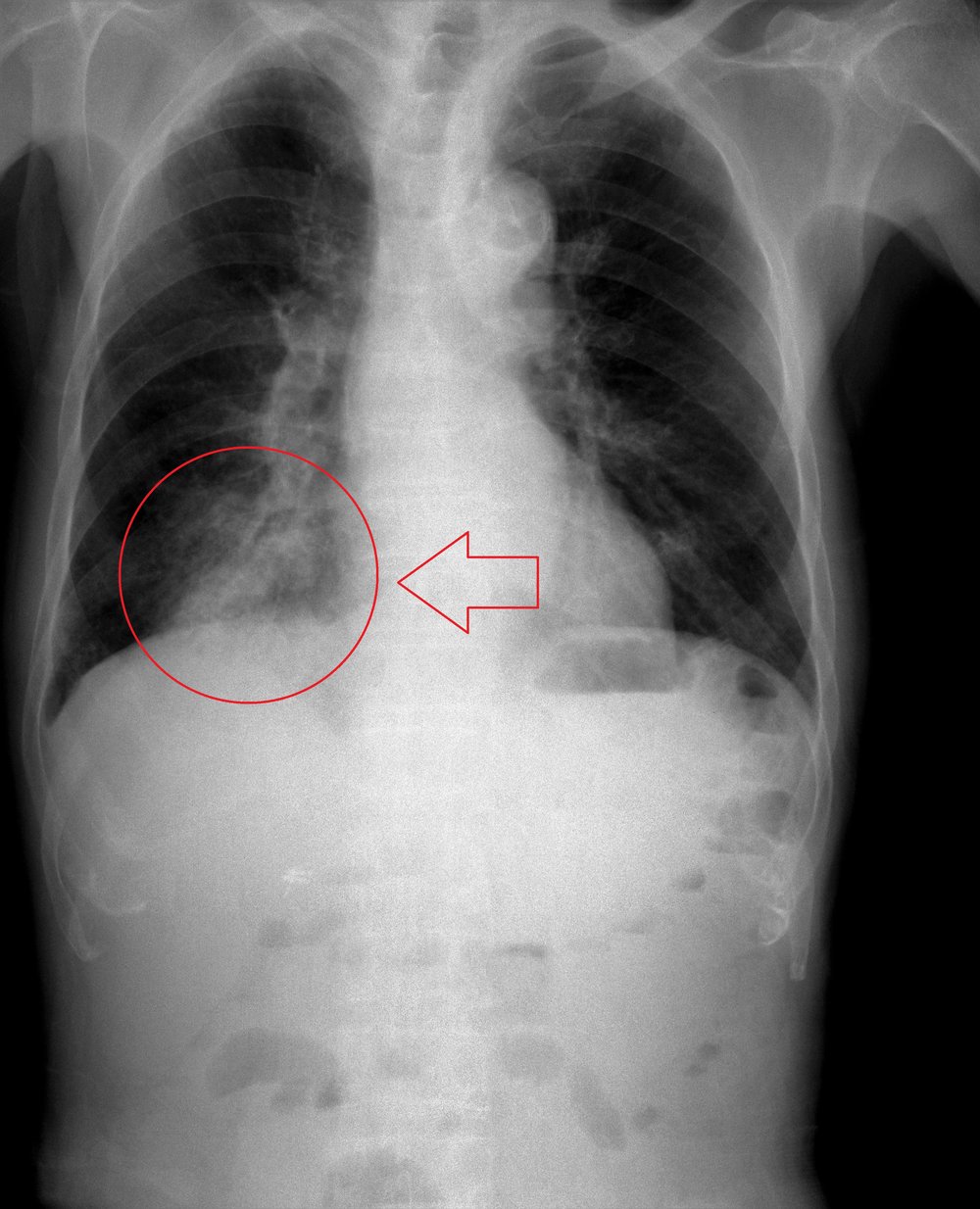 Download Gambaran Radiologi Pneumonia Nomer 18