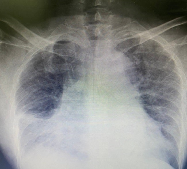 Detail Gambaran Radiologi Pneumonia Nomer 19