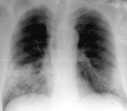 Detail Gambaran Radiologi Pneumonia Nomer 23