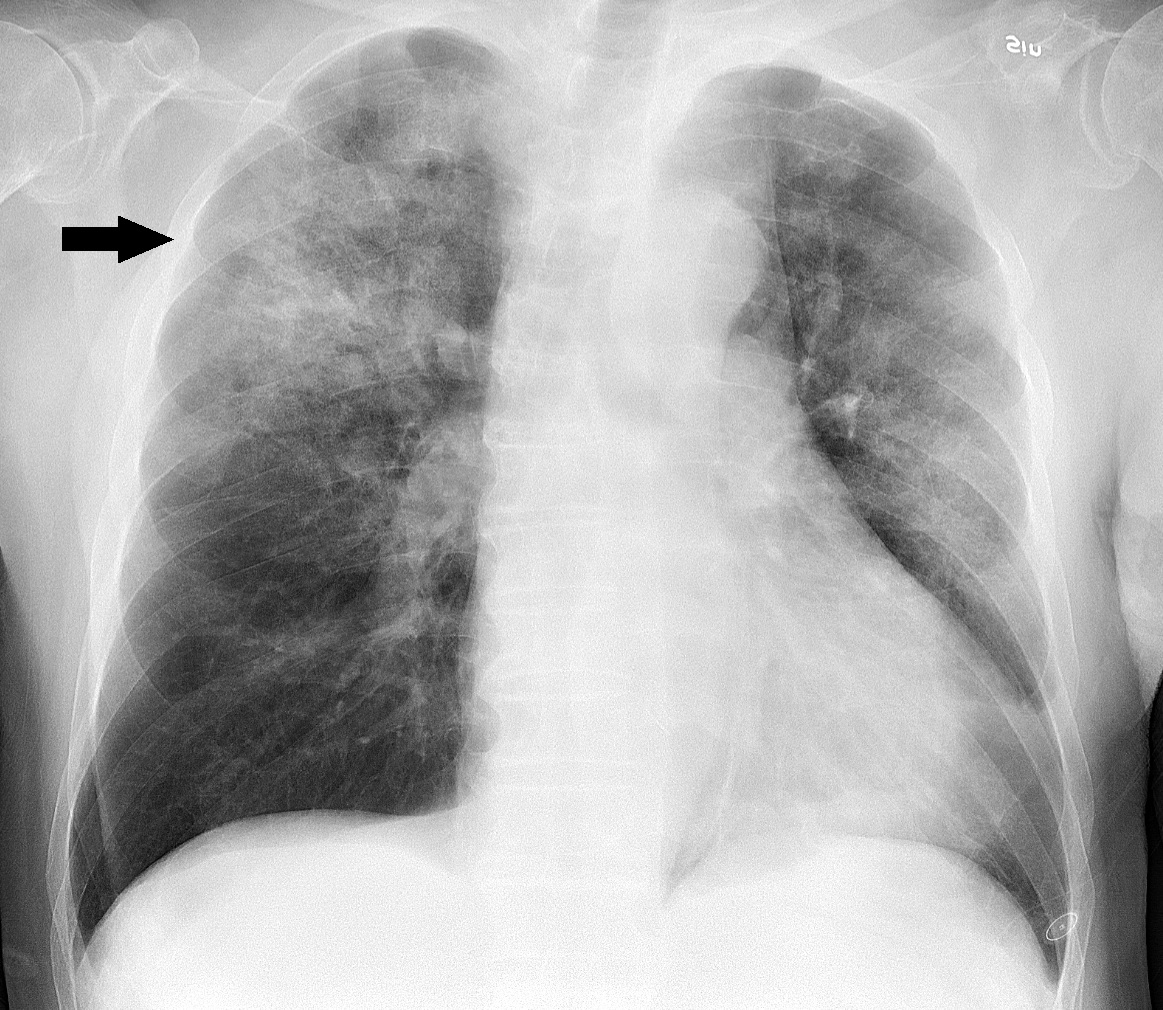 Detail Gambaran Radiologi Pneumonia Nomer 3