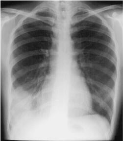 Detail Gambaran Radiologi Pneumonia Nomer 26