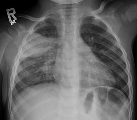 Detail Gambaran Radiologi Pneumonia Nomer 28
