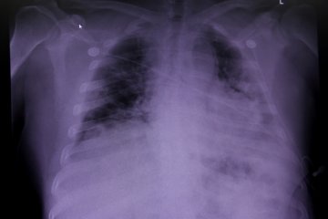 Detail Gambaran Radiologi Pneumonia Nomer 29