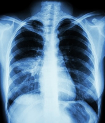Detail Gambaran Radiologi Pneumonia Nomer 4