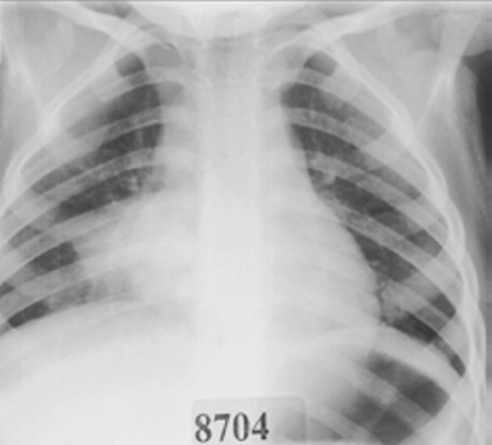 Detail Gambaran Radiologi Pneumonia Nomer 32