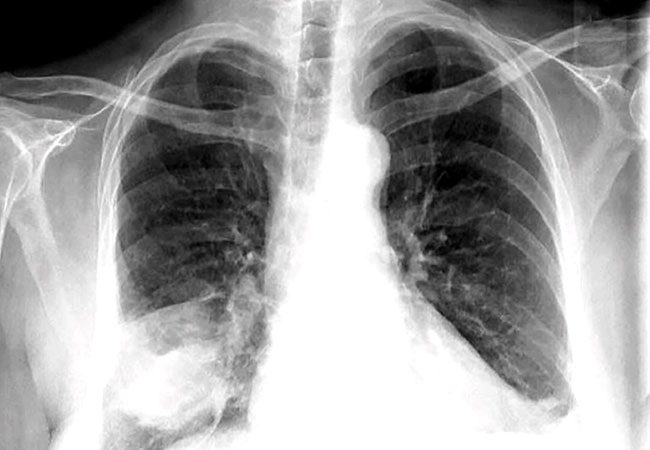 Detail Gambaran Radiologi Pneumonia Nomer 33