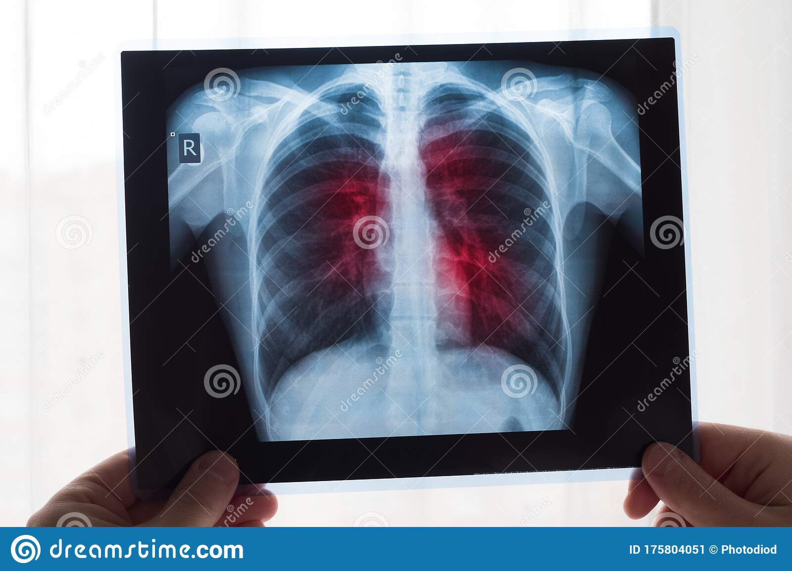 Detail Gambaran Radiologi Pneumonia Nomer 36