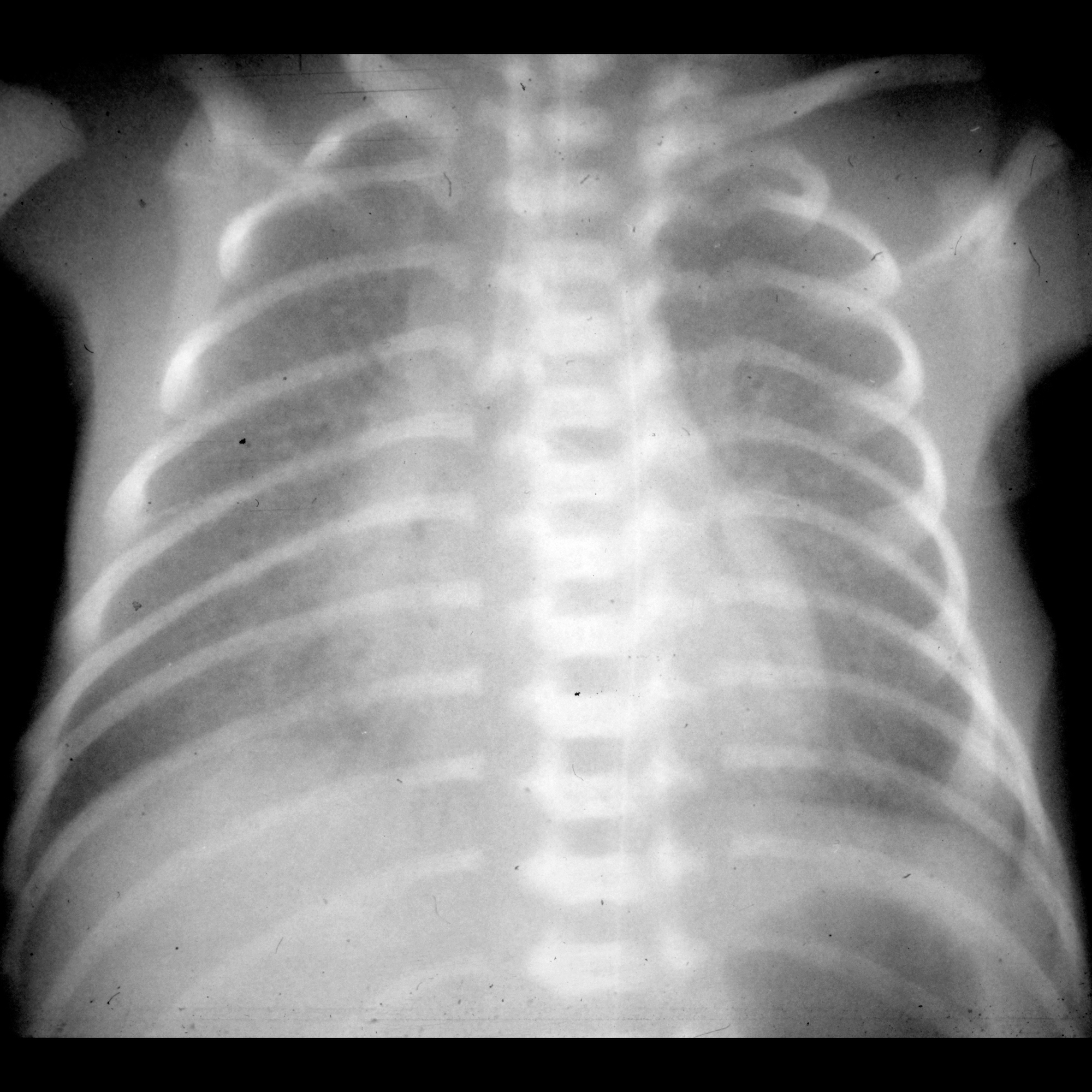 Detail Gambaran Radiologi Pneumonia Nomer 37