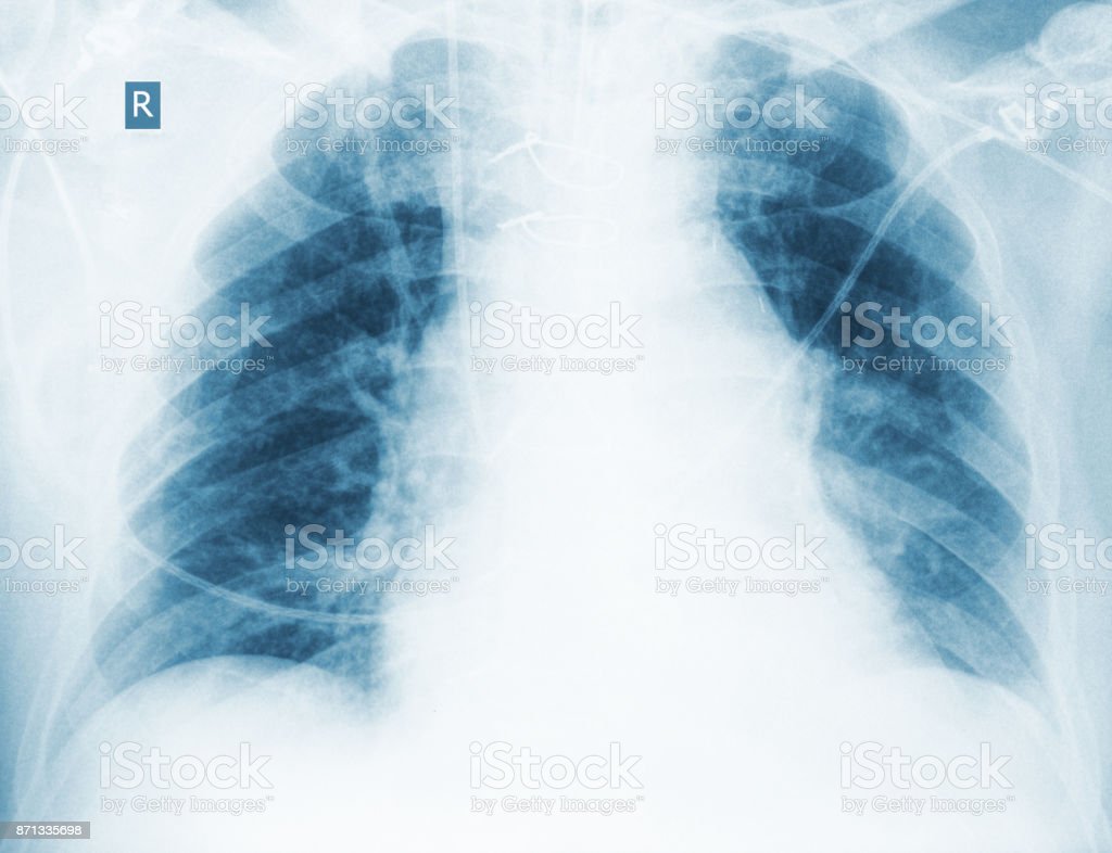 Detail Gambaran Radiologi Pneumonia Nomer 38