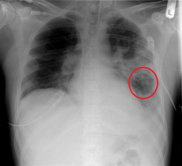 Detail Gambaran Radiologi Pneumonia Nomer 39