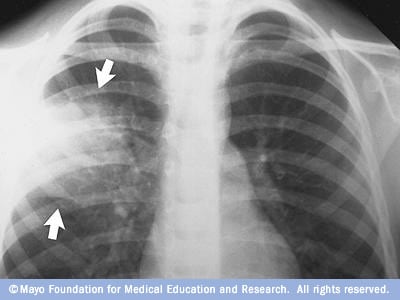 Detail Gambaran Radiologi Pneumonia Nomer 41