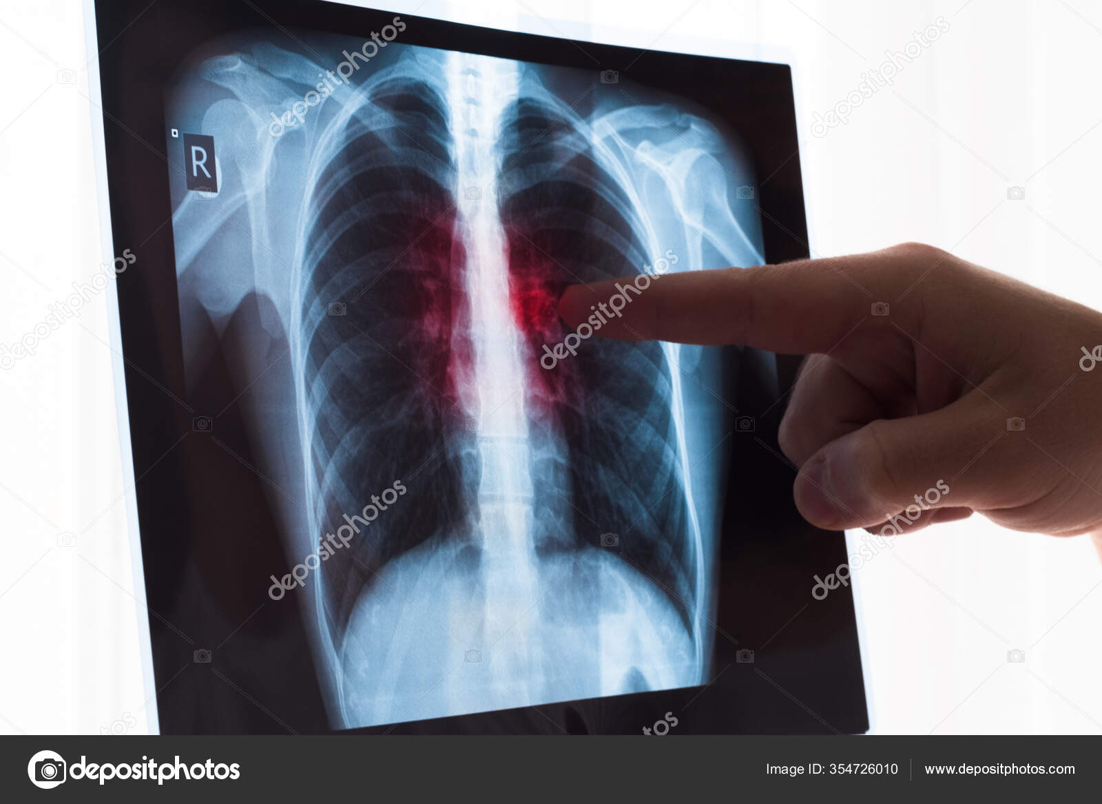 Detail Gambaran Radiologi Pneumonia Nomer 42