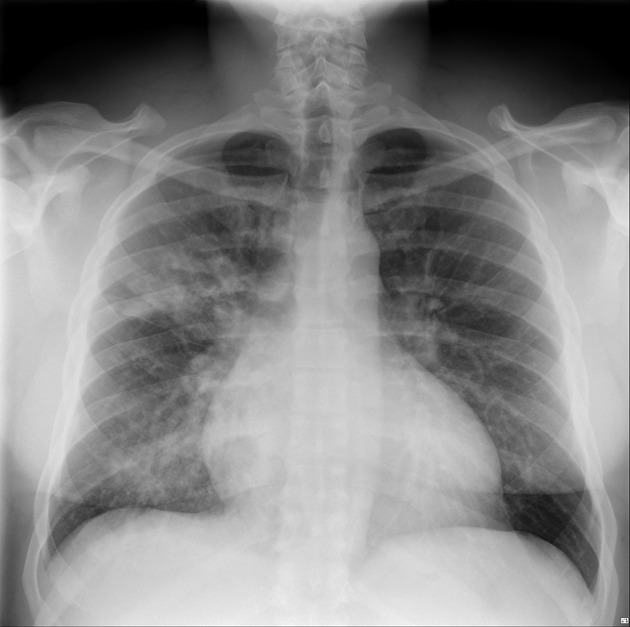 Detail Gambaran Radiologi Pneumonia Nomer 7