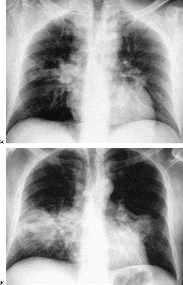 Detail Gambaran Radiologi Pneumonia Nomer 9