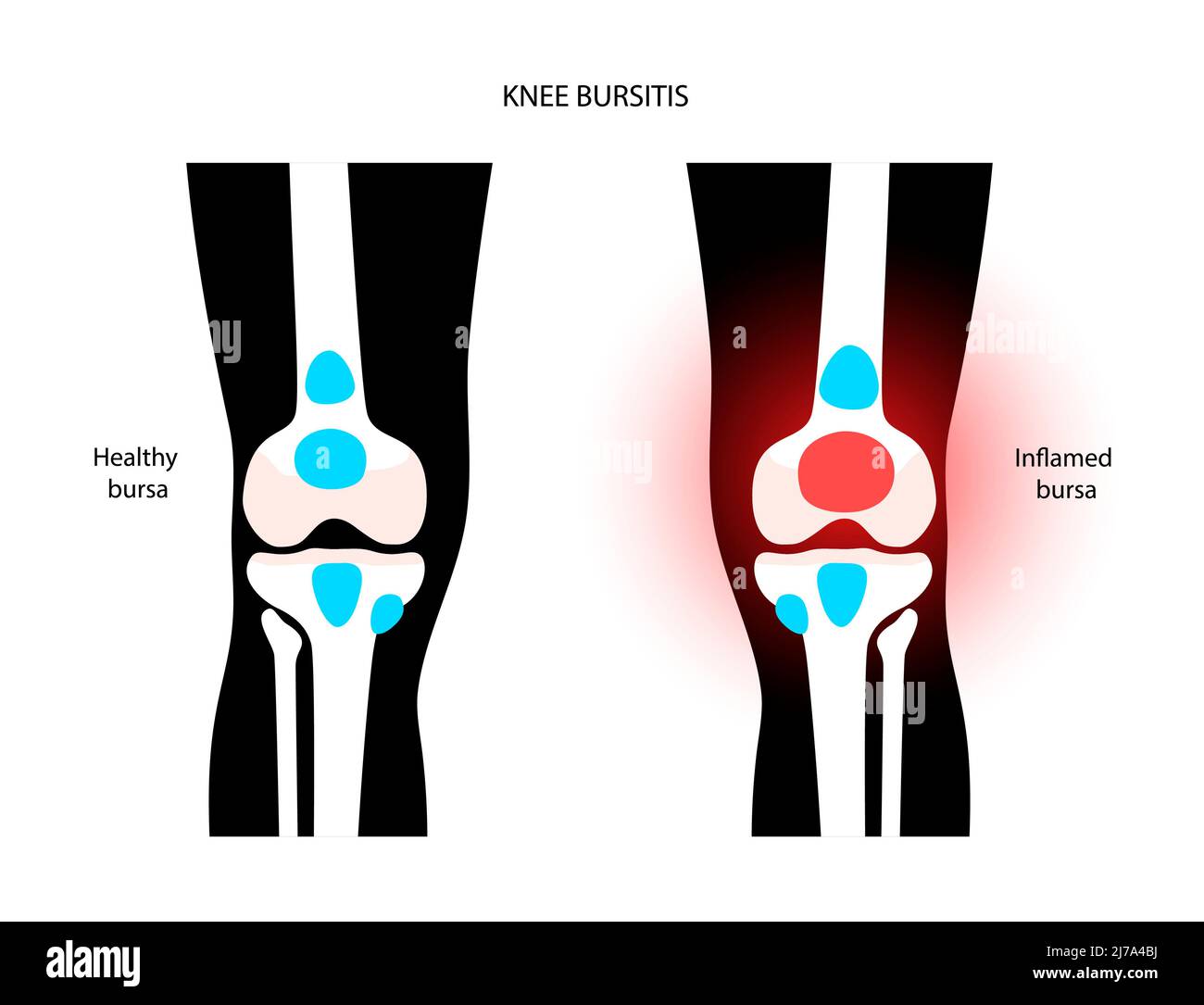 Bursitis Knie Bilder - KibrisPDR