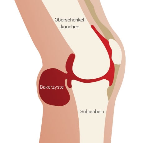 Detail Bursitis Knie Bilder Nomer 5