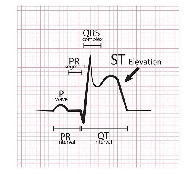 Detail Contoh Gambar Ekg Stemi Nomer 7