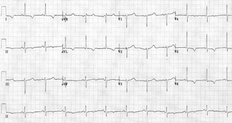 Detail Contoh Gambar Ekg Stemi Nomer 12