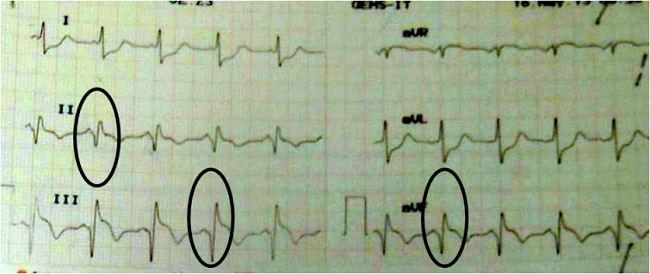 Detail Contoh Gambar Ekg Stemi Nomer 13