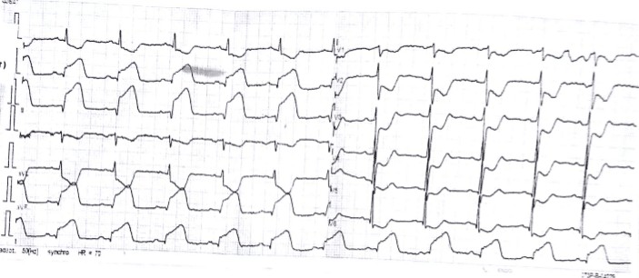 Detail Contoh Gambar Ekg Stemi Nomer 15