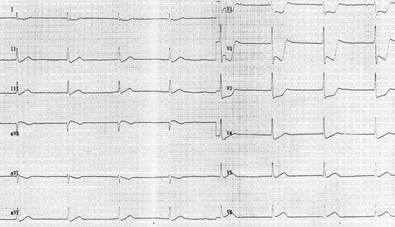 Detail Contoh Gambar Ekg Stemi Nomer 18