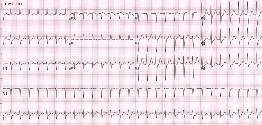 Detail Contoh Gambar Ekg Stemi Nomer 20