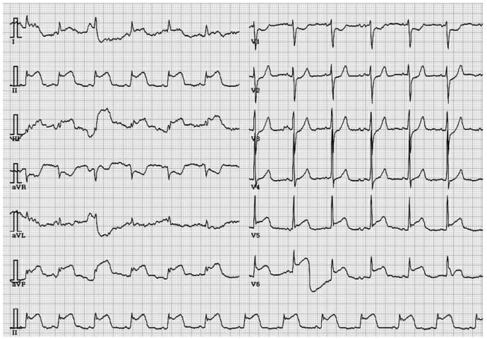 Detail Contoh Gambar Ekg Stemi Nomer 3