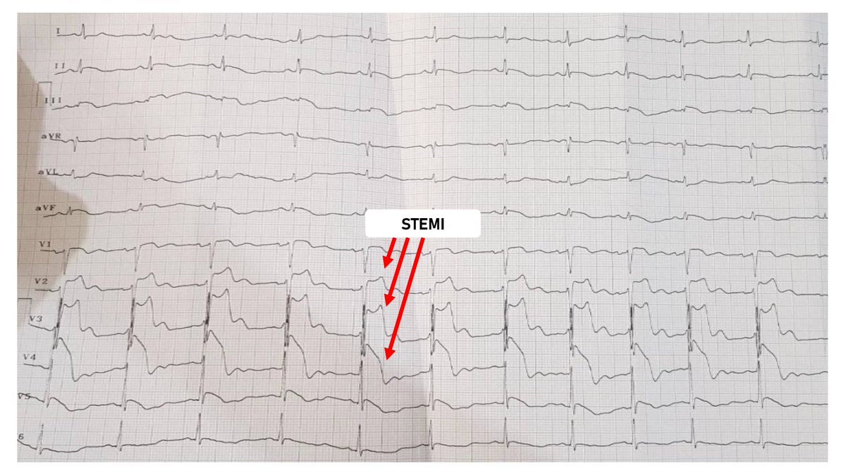 Detail Contoh Gambar Ekg Stemi Nomer 23