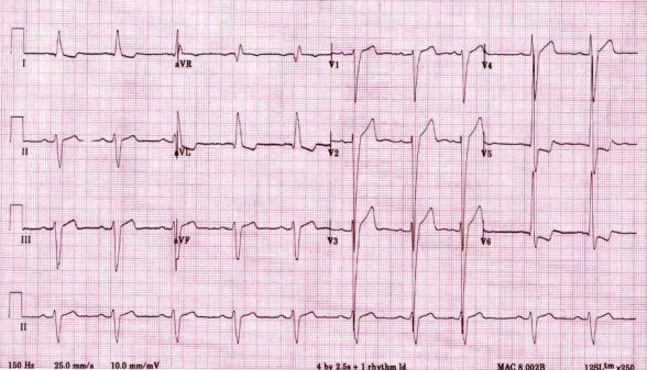 Detail Contoh Gambar Ekg Stemi Nomer 28