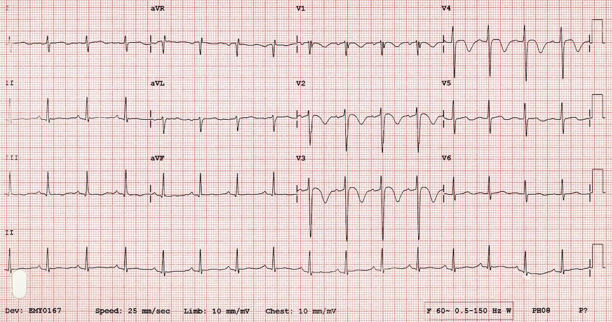 Detail Contoh Gambar Ekg Stemi Nomer 33