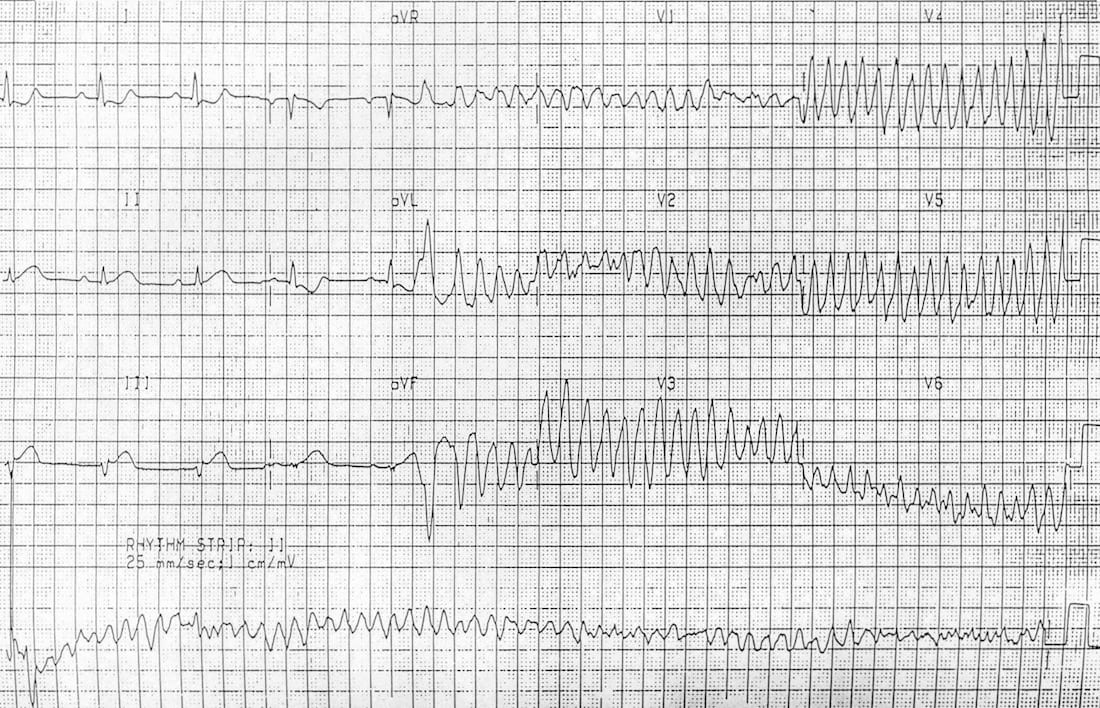 Detail Contoh Gambar Ekg Stemi Nomer 35