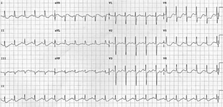 Detail Contoh Gambar Ekg Stemi Nomer 5