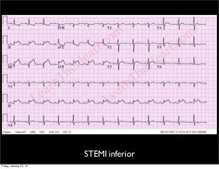 Detail Contoh Gambar Ekg Stemi Nomer 37