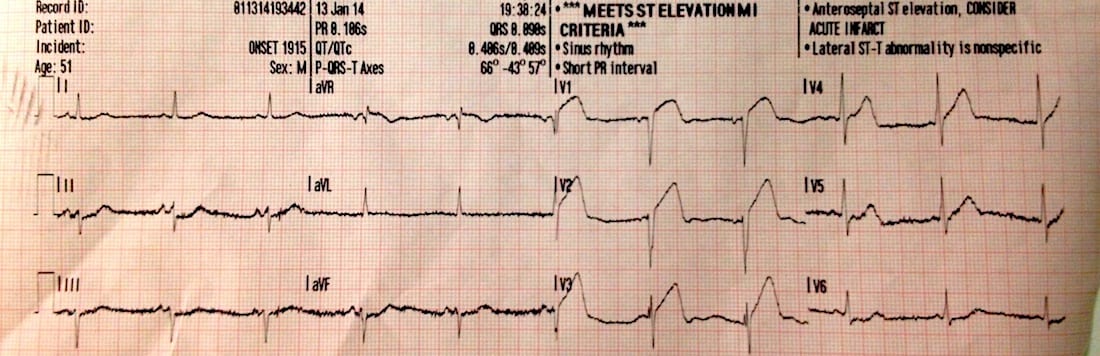 Detail Contoh Gambar Ekg Stemi Nomer 41