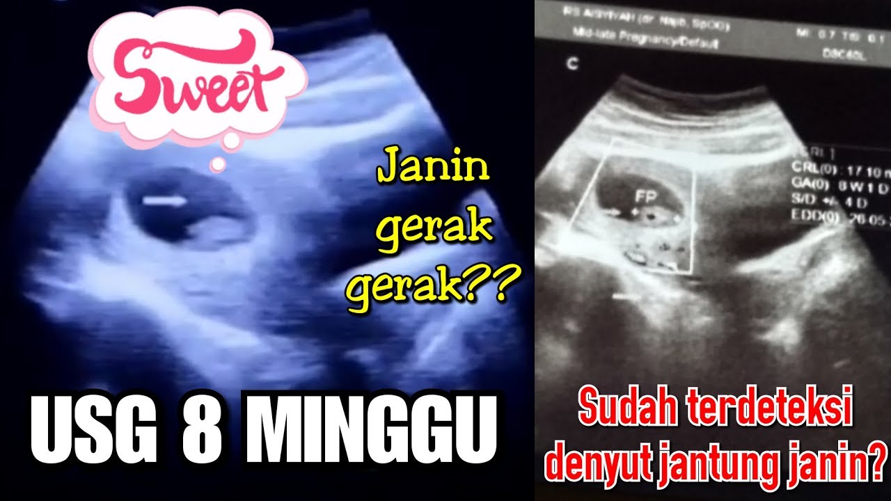 Detail Contoh Gambar Janin 8 Minggu Nomer 12