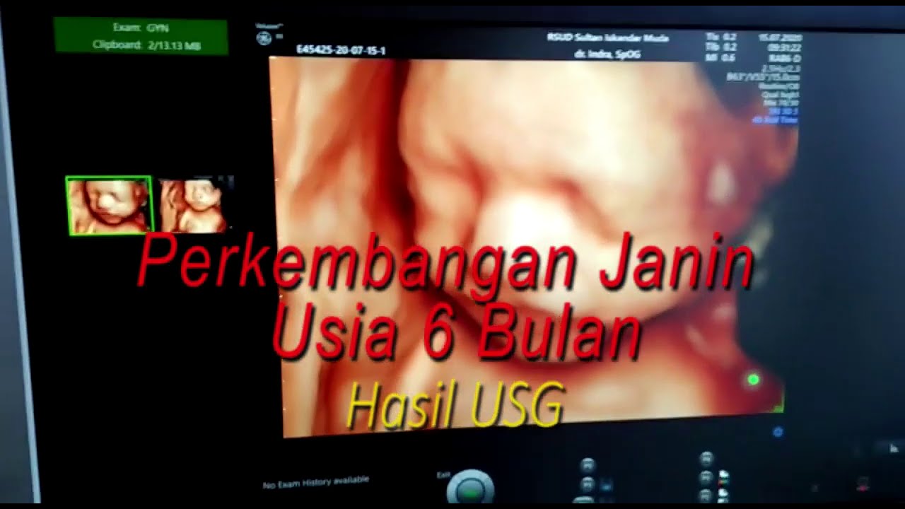 Detail Contoh Gambar Janin Usia 6 Bulan Nomer 7