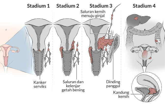 Contoh Gambar Kanker Serviks - KibrisPDR