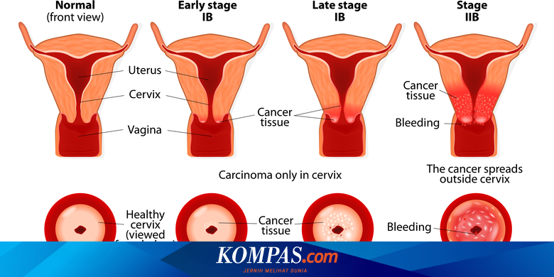 Detail Contoh Gambar Kanker Serviks Nomer 2