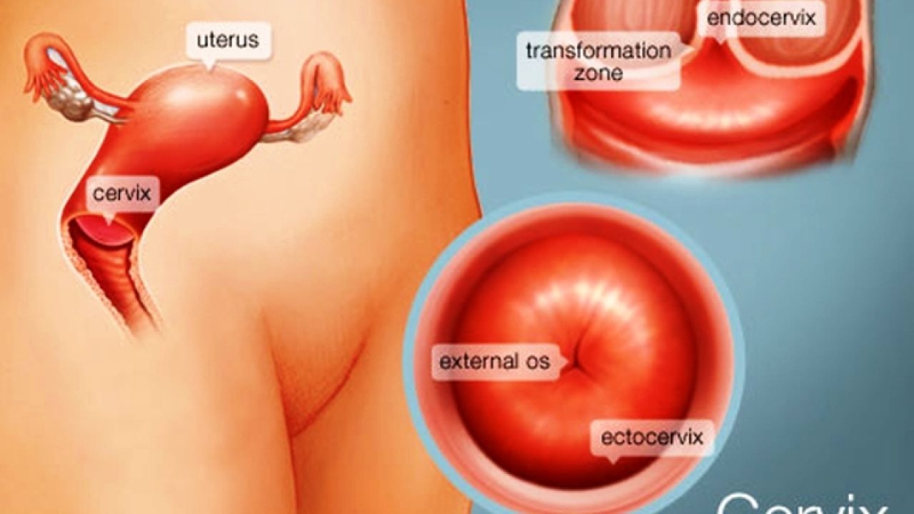 Detail Contoh Gambar Kanker Serviks Nomer 21