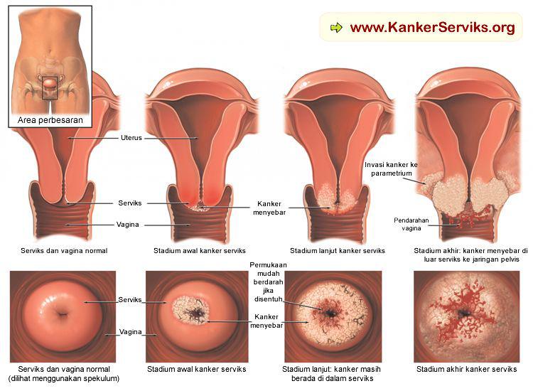 Detail Contoh Gambar Kanker Serviks Nomer 8