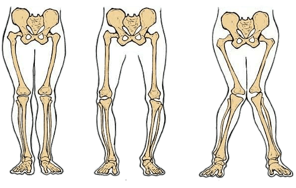 Detail Contoh Gambar Kelainan Tulang Nomer 42